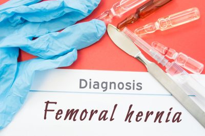 Surgical Removal of Femoral Hernia – An Explanation
