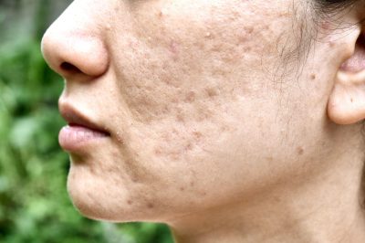 All About The Causes, Triggers, and Treatment for Cystic Acne